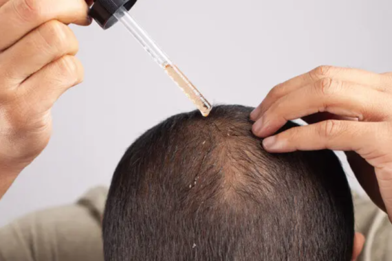 hairloss-solution-mittalskinclinic