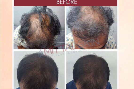 hair-tranplant-in-jaipur-mittalskinclinic