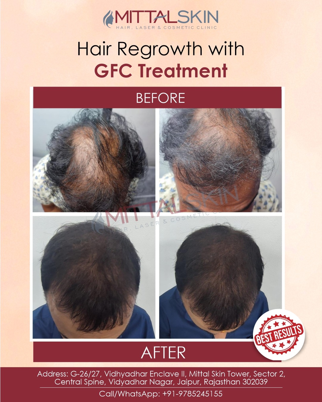 hair-tranplant-in-jaipur-mittalskinclinic