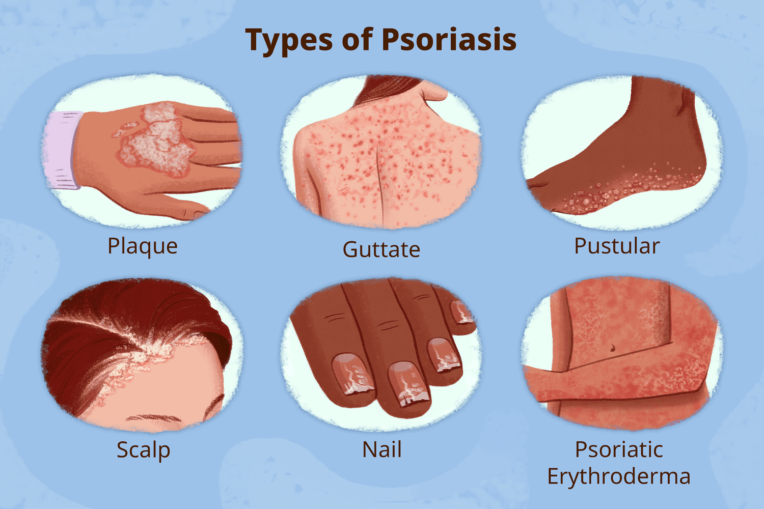 psoriasis-treatment-in-jaipur